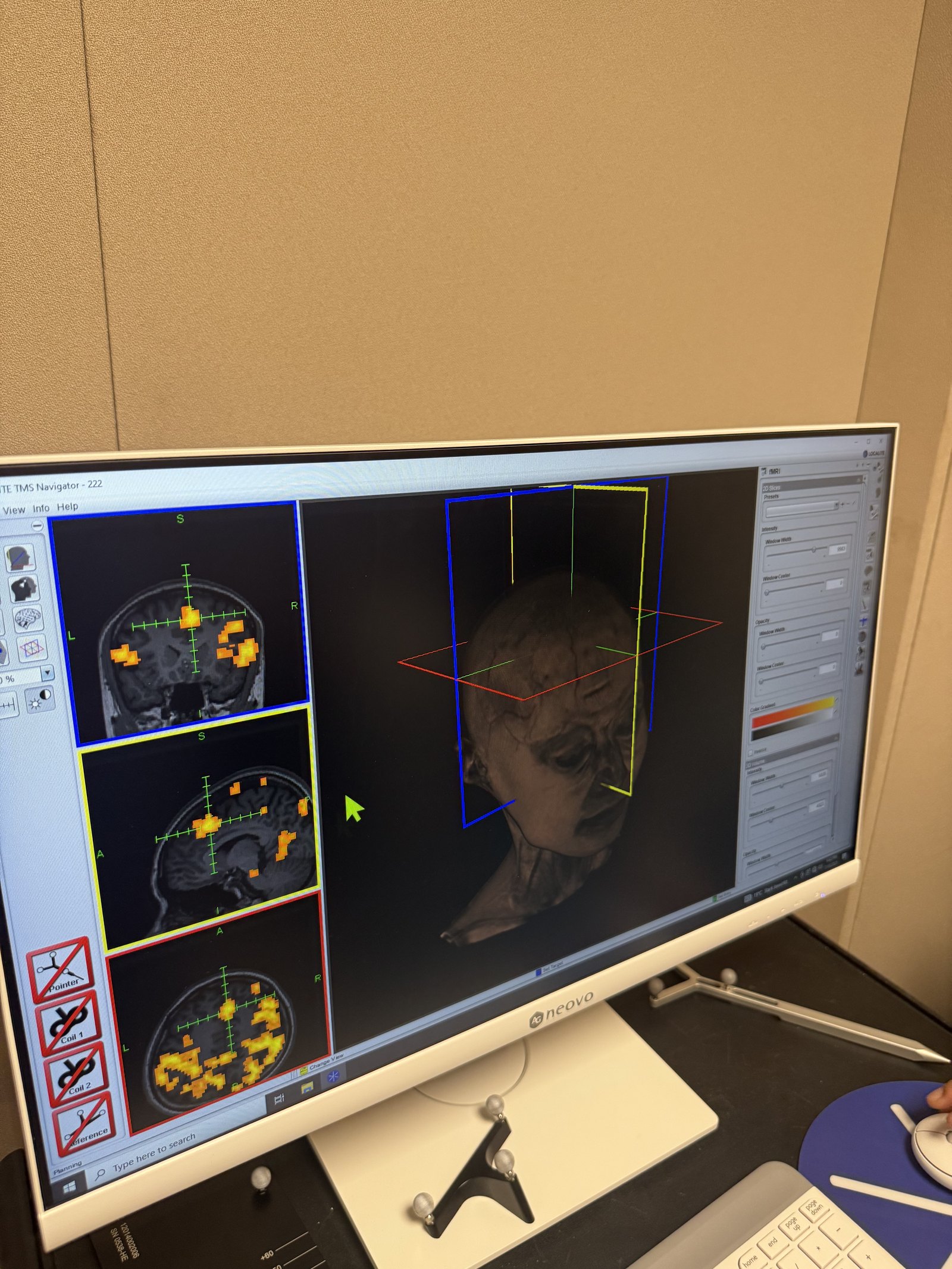 The Localite TMS Navigator screen showing a 3D reconstruction of a participant's head with fMRI-based targets