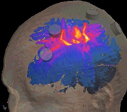 Electric-field modeling render on a 3D brain showing the targeted region for temporal-interference stimulation